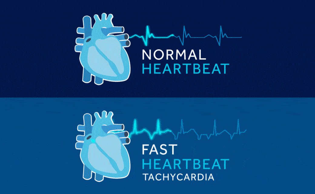 Tachycardia Taking Care Of Your Heart